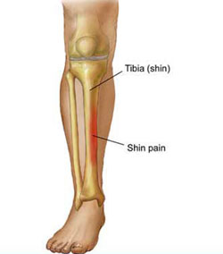 Shin Bone Pain