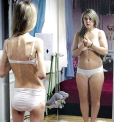 Image result for before and after anorexia