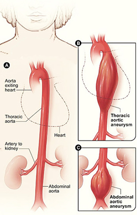 Thoracic Endografts Removes Tumors in the Aorta