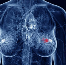  New Method to Better Detect Breast Cancer