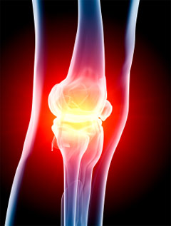 Cartilage Damage Helps Detect Osteoarthritis?