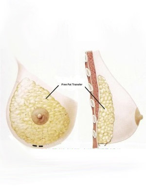 Fat Grafts Used for Breast Augmentation
