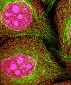 'Heat maps' find cervical cancer