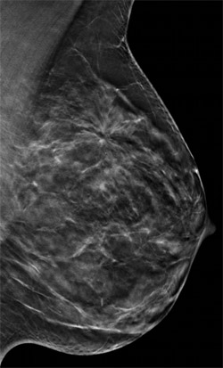 3-D Mammography