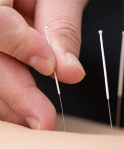 Bothered by hot flashes? Acupuncture might be the answer, analysis suggests   