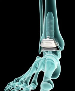 Ankle Replacement   