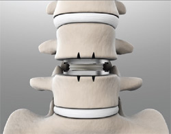 Joint Replacement for the Spine