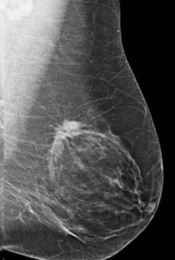 Risk-based screening misses breast cancers in women in their forties