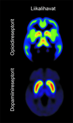 Obesity is associated with brain's neurotransmitters  