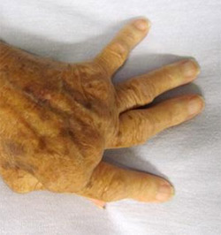 Gene variants show potential in predicting rheumatoid arthritis disease outcomes 