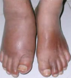 Charcot foot, a crippling diabetes complication, is increasing: A Study 