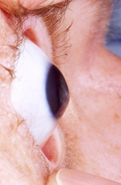 Graves’ Disease Shows Up in Your Eyes 