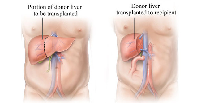 Live-Liver-Donation