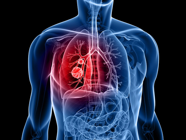 Lung-cancer-survival