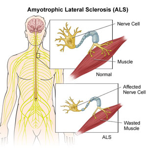  Amyotrophic lateral sclerosis