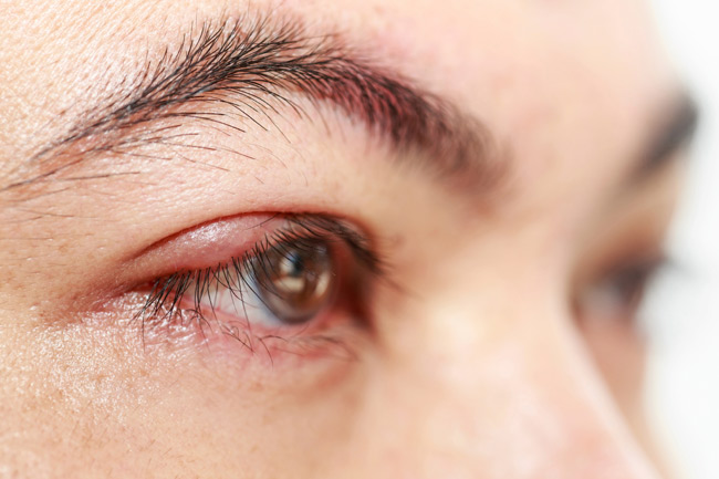 Granulated Eyelids or Blepharitis