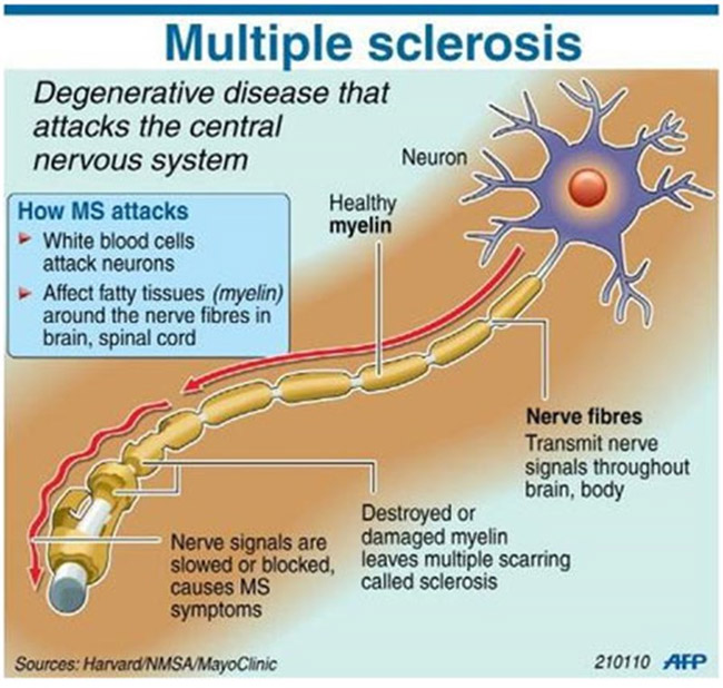 What Is Multiple Sclerosis 