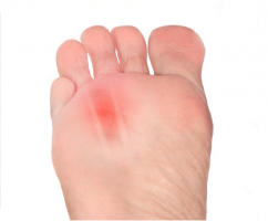 Morton’s Neuroma Surgery - Tips On How To Best Prepare Recoup - Women 