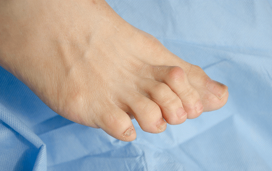 Types Of Hammer Toe Deformity Design Talk